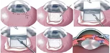 “高大上”青光眼治疗技术保住青年视力——青光眼微型引流钉植入手术介绍
