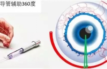 山东省微创治疗先天性青光眼新技术3.0上线，了解一下——微导管辅助的内路360°小梁切开术治疗先天性青光眼取得可喜的效果