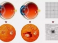 老年黄斑变性对视力有什么样的损害?