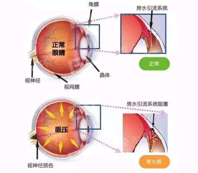 眼胀 头痛 恶心呕吐 或许该去看看眼科 眼科科普 医院新闻 山东中医药大学附属眼科医院 山东施尔明眼科医院 山东省儿童眼科医院 官方网站