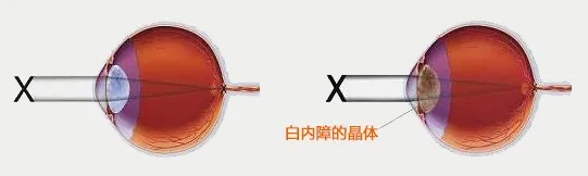 老年人要警惕“老眼昏花”！(图1)