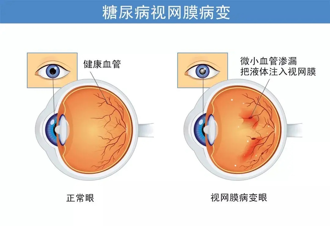 老年人要警惕“老眼昏花”！(图4)