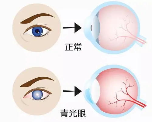 老年人要警惕“老眼昏花”！(图5)