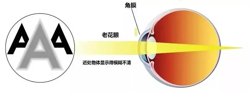 老年人要警惕“老眼昏花”！(图3)