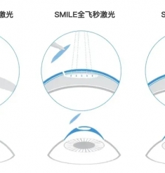 做一次激光近视手术，到底要多少钱？