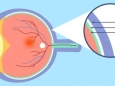 眼球的“血库”生出“杂草” 早期无症状，晚期可致盲！
