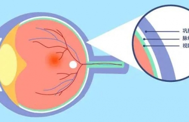 眼球的“血库”生出“杂草” 早期无症状，晚期可致盲！