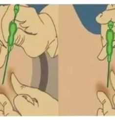 埋线助您心明眼亮身材好！