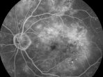 糖尿病性视网膜病变为什么要“打激光”?